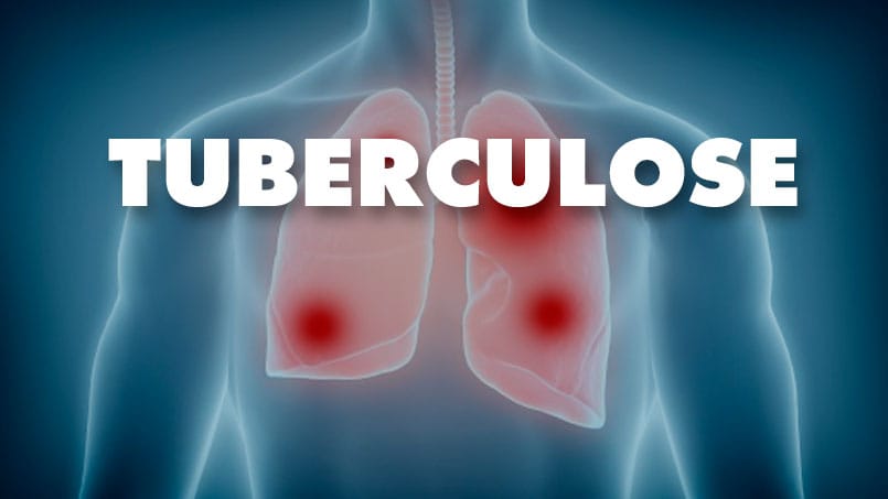 Tuberculose continua como ameaça de saúde pública no Brasil apesar de avanços globais