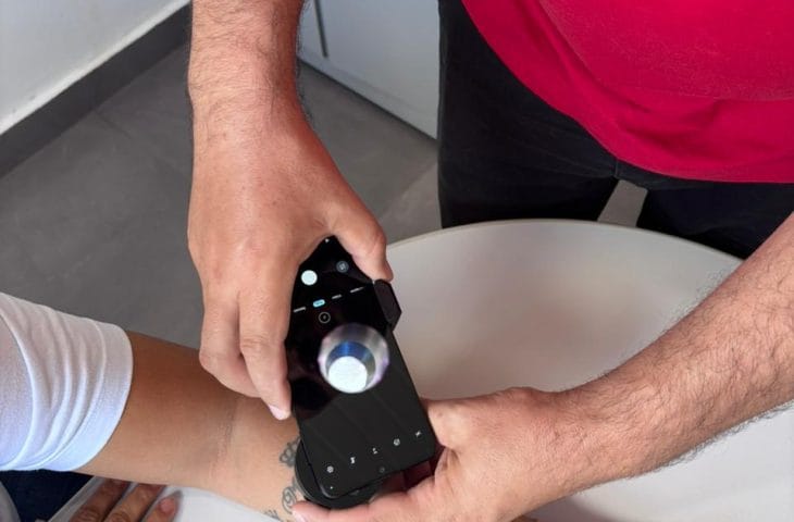 Telediagnóstico em dermatologia amplia acesso e identifica casos de câncer de pele em MS