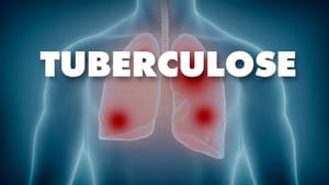 Tuberculose continua como ameaça de saúde pública no Brasil apesar de avanços globais