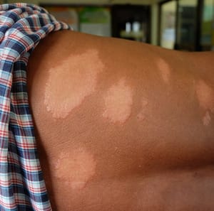 Prefeitura de Cuiabá-MT intensifica ações de conscientização e combate à hanseníase